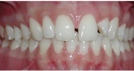 Smile with large gaps between top teeth